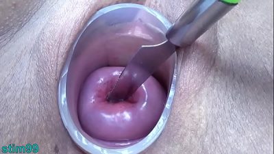 Hot Lesbians Get Prolapse Cervix With Catheters